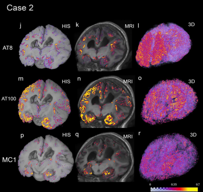 The colors of Alzheimer’s abnormal proteins: AT8, AT100 and MC1 quantitative heatmap registered to blockface (first column), MRI (second column) of patient “Case 2.” The third column depicts the respective 3D renderings of each tau map. AT8 detected higher amounts of tau than AT100 and MC1. (Credit: Daniela Ushizima, Berkeley Lab)